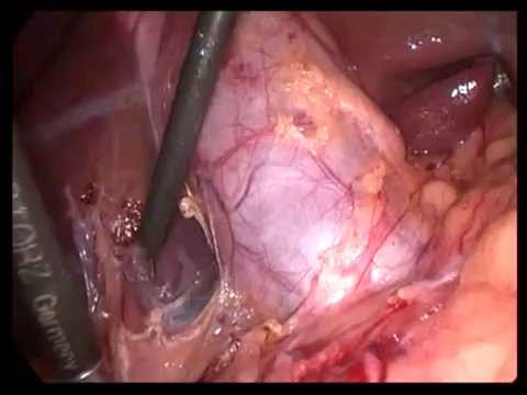 Lap Cholecystectomy Unedited 419 Strong Omental Adhesion In A Bad GB
