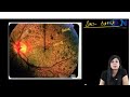 Ophthalmology PYQs_FMGE_31 || Dr. Niha Aggarwal