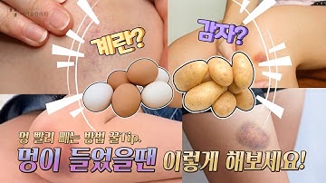 멍 빨리빼는 방법 꿀TIP [멍이 들었을땐 이렇게 해보세요!]