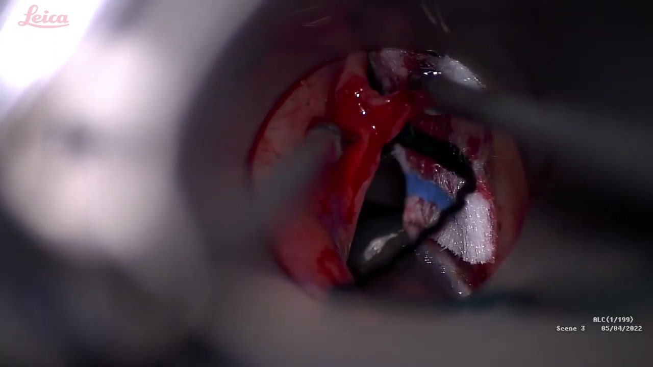 Stripping of VFs lesion Bilaterally with rose petals music