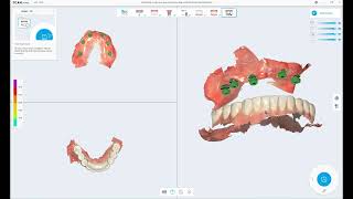 FREEDOM Air / All on 6 case (Scanbody bite scanning)