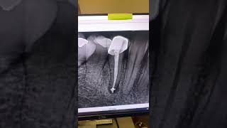 A Wouldve Extracted This Tooth