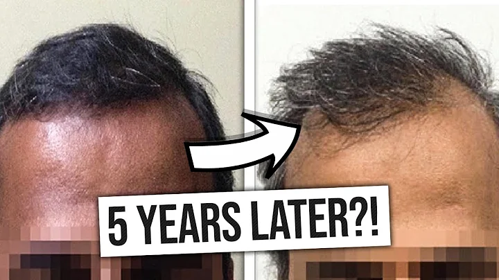 Hair Transplants: Do They Last Forever? - The Truth - DayDayNews