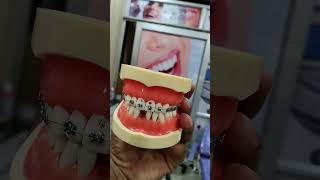 RPD DENTURE #dentistfromgkp #teeth #dentist #implant #smile #shorts #