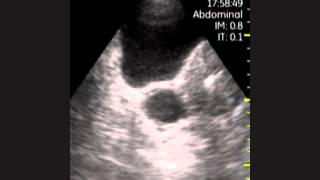Ovarian Cyst And Iud. Pelvic Explo With Vscan Ultrasound.