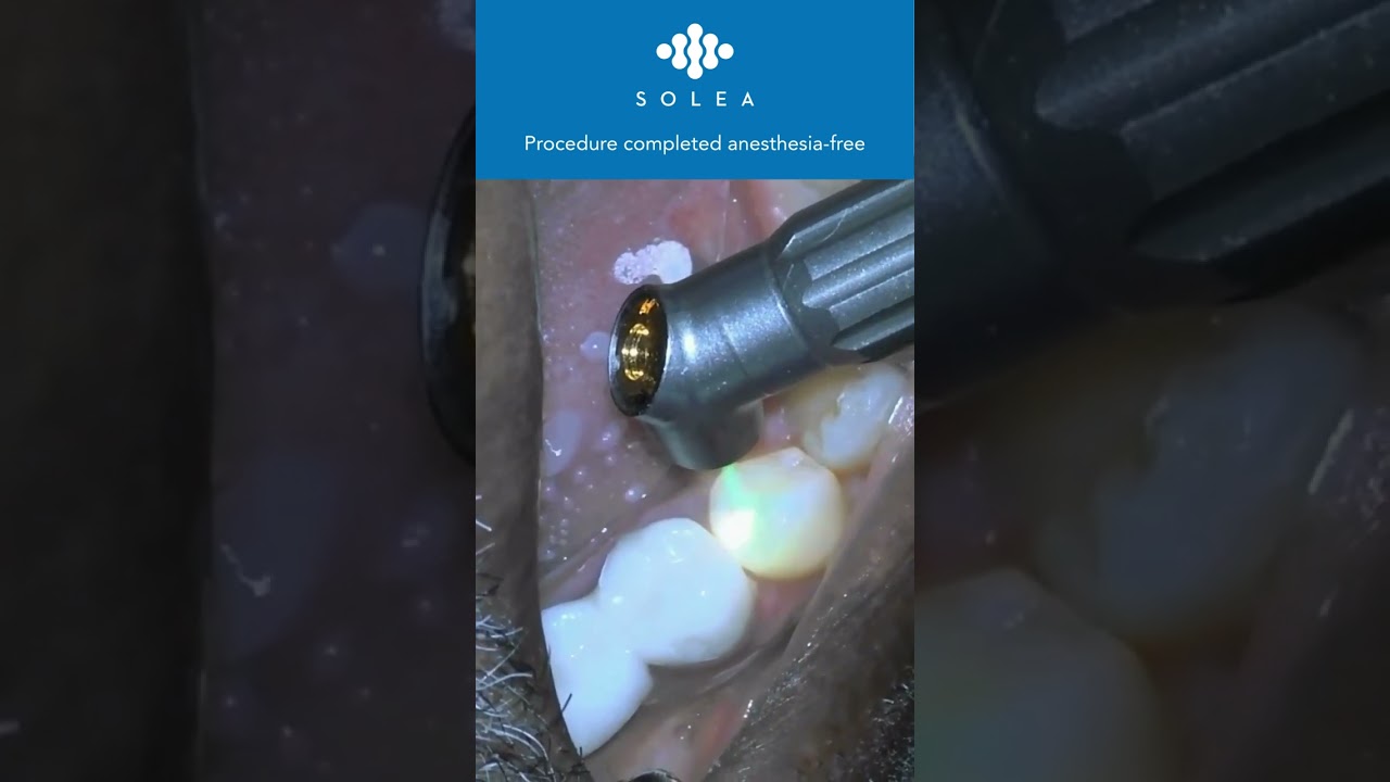 Solea Class II Procedure by Dr. Wayne Holler
