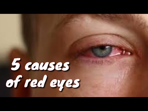 Beware 5 causes of red eyes that we often experience