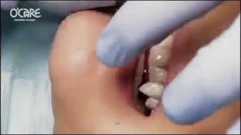 Cần cảnh làm răng nanh giống ma cà rồng