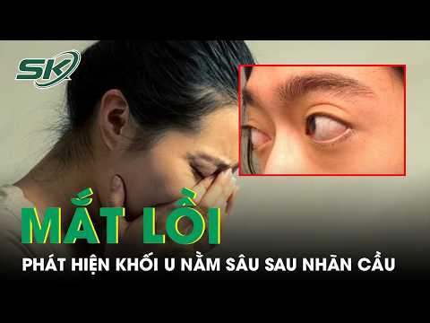 Abnormal Eye Protrusion: 45-Year-Old Woman Discovers Tumor Deep Behind Eyeball | SKDS