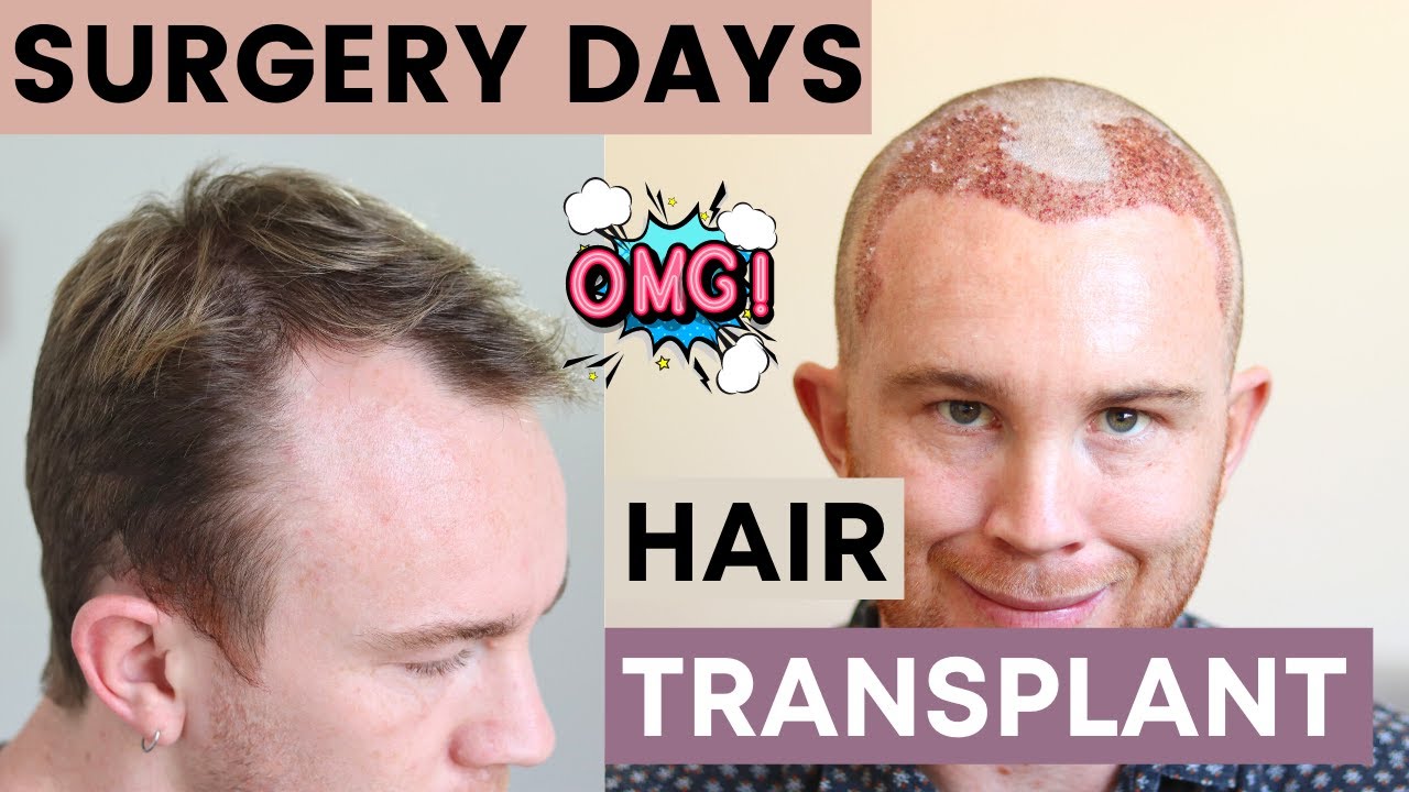 2. Blonde Hair Transplant Options - wide 8