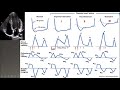 diastolic dysfunction part II-grading ASE 2016