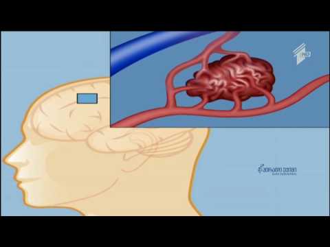 თავის ტვინის სისხლძარღვთა პათოლოგიები - სიმპტომები და რისკები