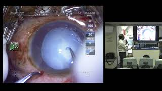 Lecture: Management of Complications of Cataract Surgery