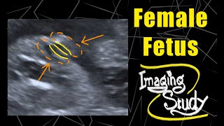 Female Fetus - It's a Girl || Ultrasound || Case 95