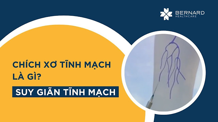 Chích xơ tĩnh mạch chi dưới bao nhiêu tiền năm 2024