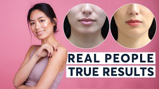 HIFU Skin Tightening | Real People, True Results