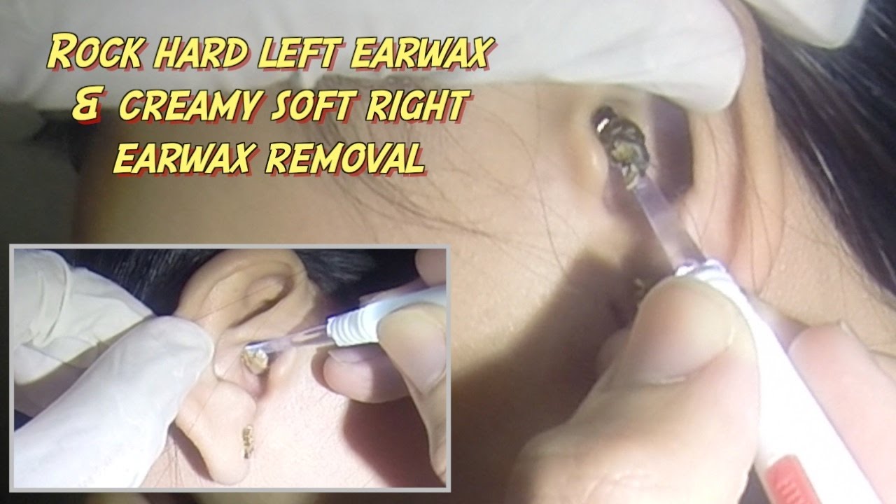 Hard Ear Wax Removal 90