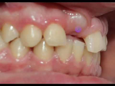 ვიდეო: სტომატოლოგებმა დაასახელეს საკვები, რომელიც აზიანებს კბილებს