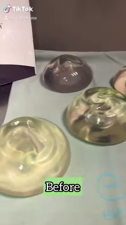 Breast Augmentation | ACTUAL PATIENT 👱🏻‍♀️