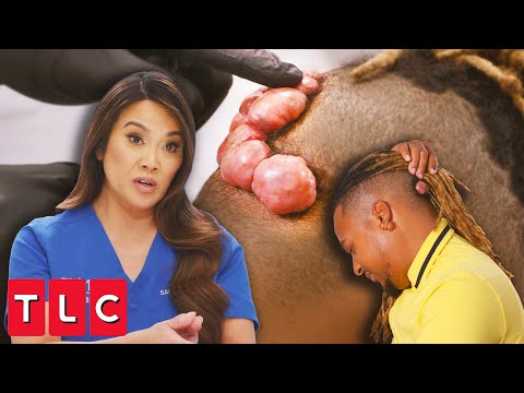 Massive Keloid Removal: Dr. Lee Calls in a Specialist (Part 1) | Dr. Pimple Popper