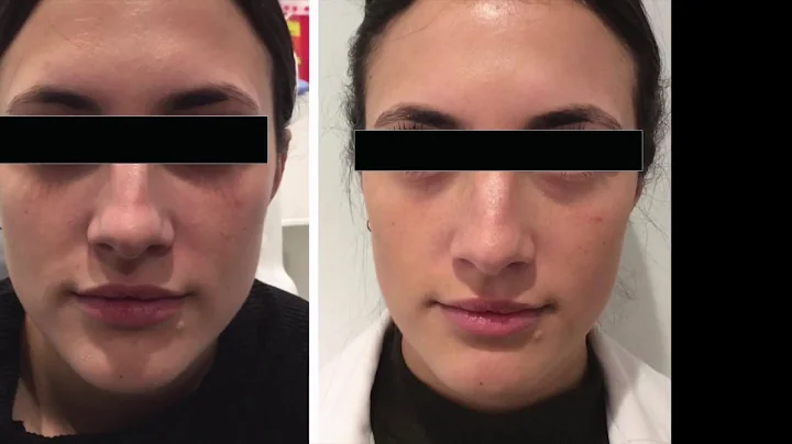 Dr. Arash Akhavan: Blood Mask NYC