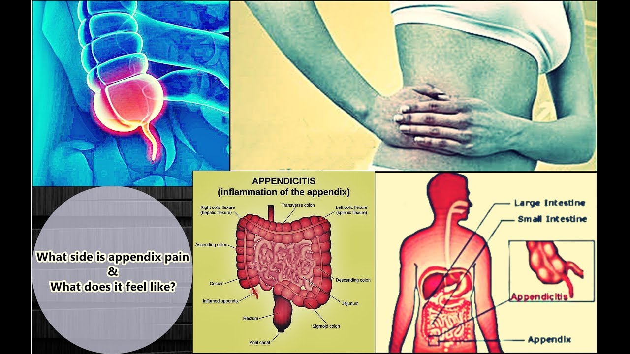 Appendix Pain - Location, Symptoms, Treatment, Causes ...