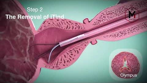 iTind? Enlarged prostate