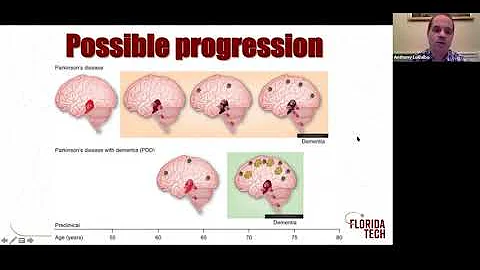 Spotlight Online - The Neuropsychology of Parkinsons - Anthony Logalbo, PhD