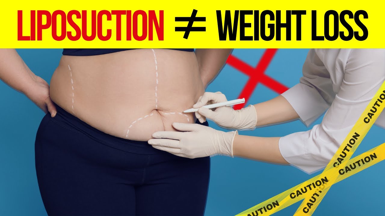 Can You Lose Weight With Liposuction?