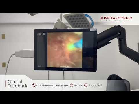 Clinical Application in Mexico | 6.3Fr Single-use Ureteroscope