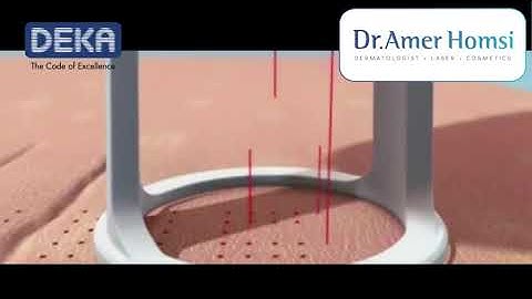 جهاز الفراكشنال ليزر co2