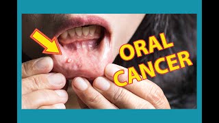 What about Oral Cancer