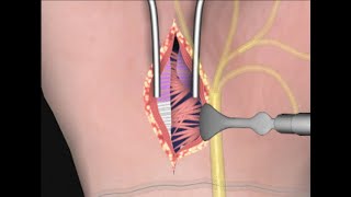 Carpal Tunnel Surgery by Cal Shipley, M.D.