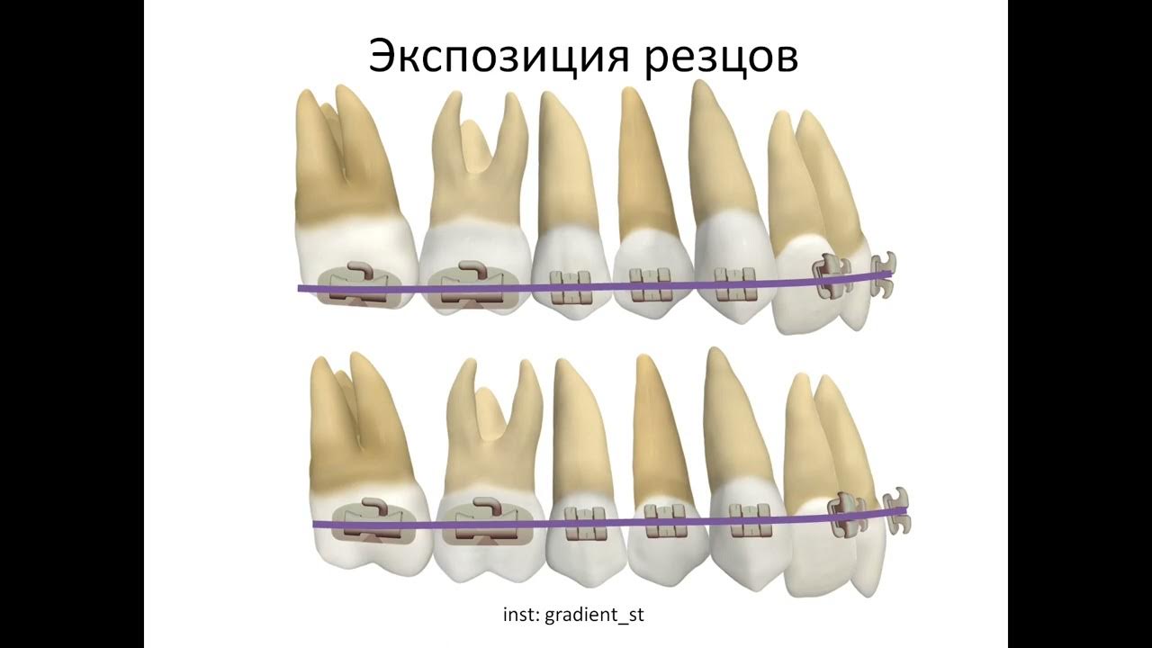 Высота позиционирования брекетов - YouTube
