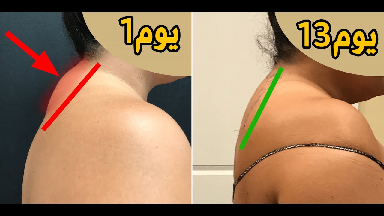 علاج تحدب الرقبة(سنام الرقبة)بنفسك فى المنزل