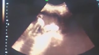 Doctor opposes language in Michigan abortion amendment
