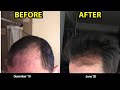 1 reason why you should be microneedling for hair loss beforeafter photos