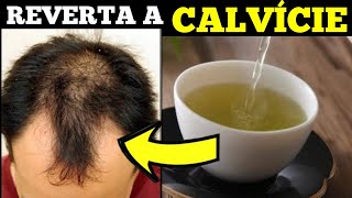 ALOPECIA ANDROGENÉTICA - Faça ESSE Poderoso Remedio Caseiro e Reverta a CALVÍCIE