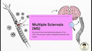 Pathogenesis and Clinical Indicators of Multiple Sclerosis: USMLE