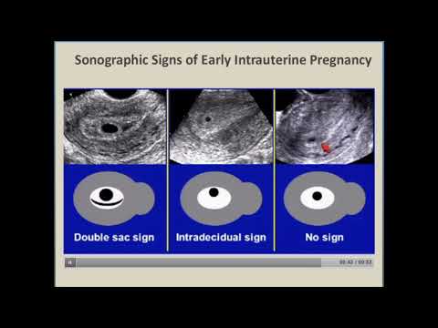 First Trimester Ultrasound non viable fetus