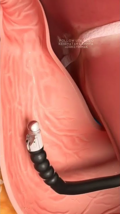 Hah? masukin kamera ke perut? #tipskesehatan #endoscope #viralshorts #kesehatantubuh
