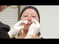 Treatment of lines around the mouth, lips and mid-face