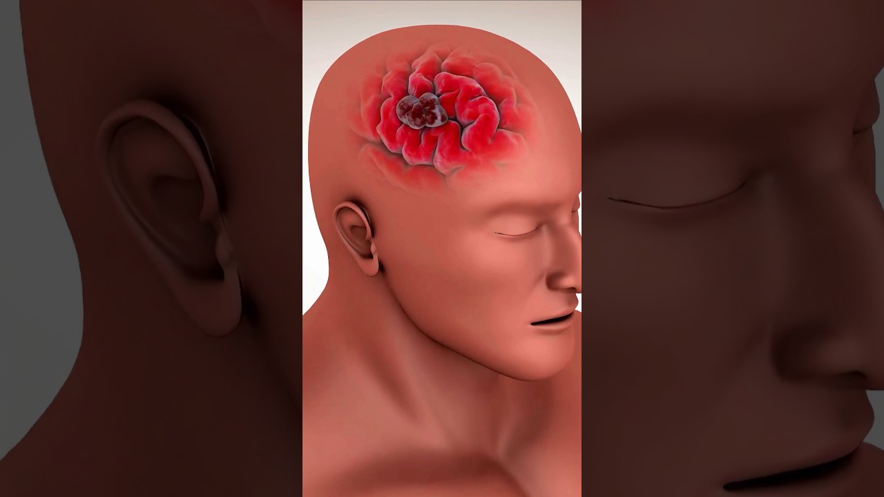 Understanding Aneurysm Clipping in 60 Seconds 