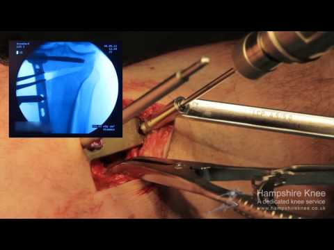 HTO - (High Tibial Osteotomy) Hampshire Knee