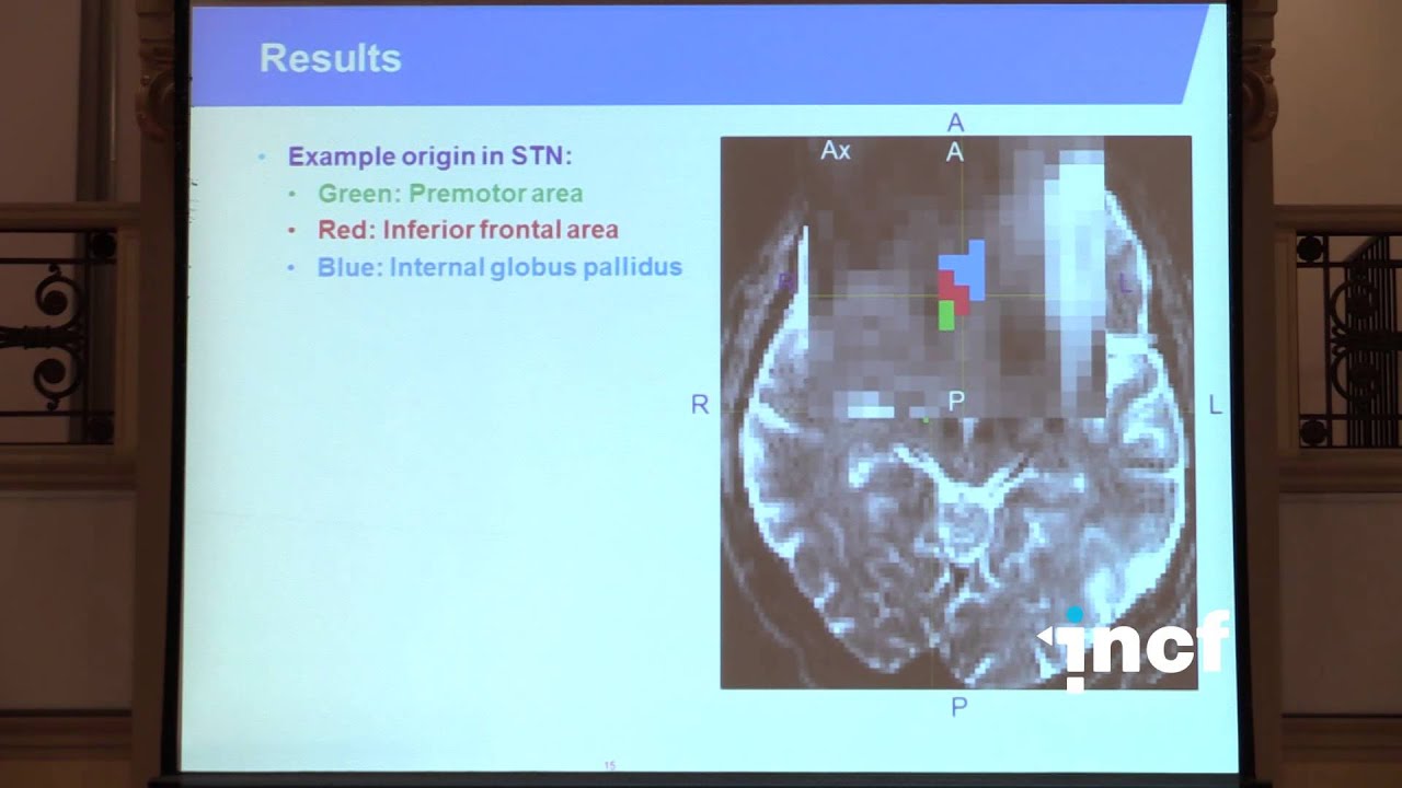 Birgit Plantinga - Ultra-high field tractography [...] of the subthalamic nucleus (2014)
