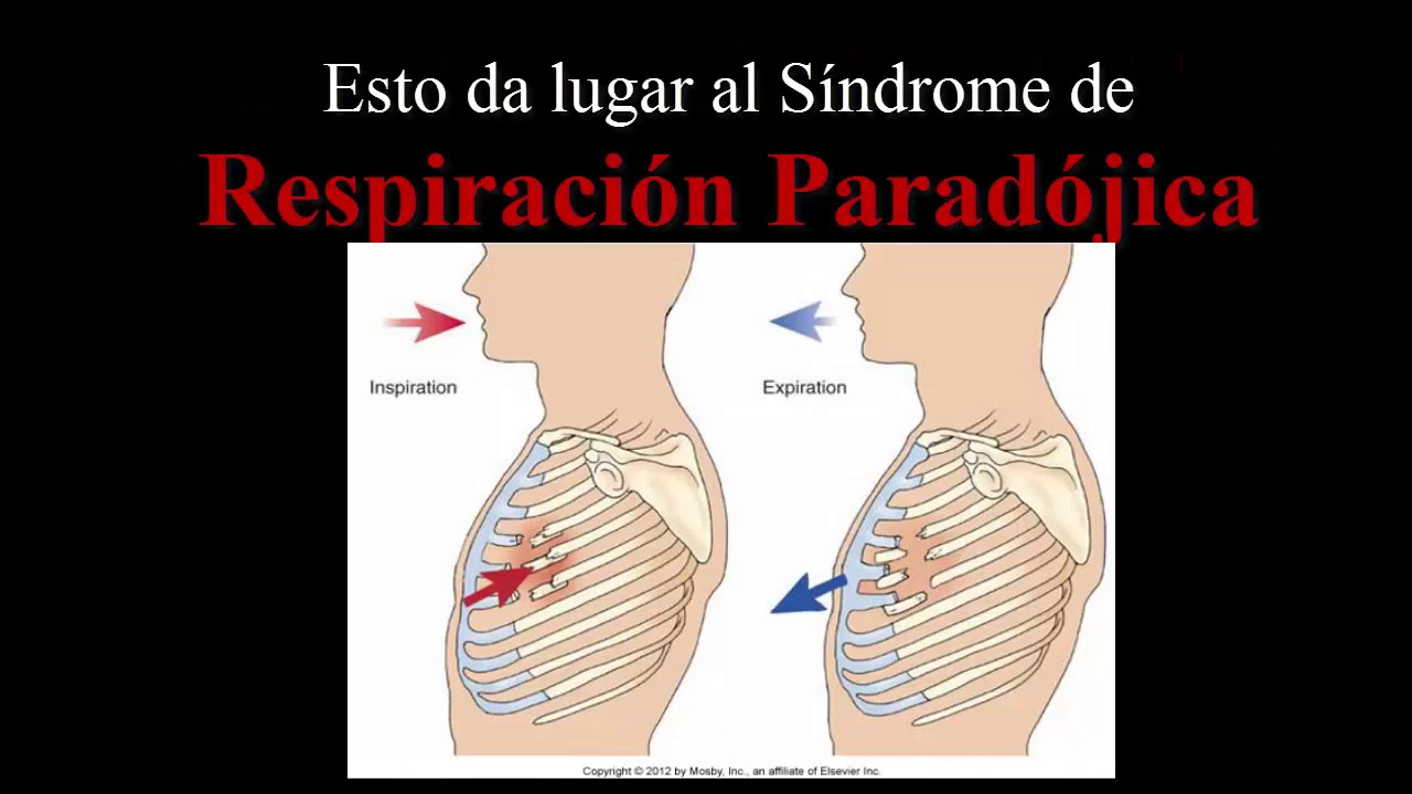 Fractura Costal y Tórax Inestable - YouTube