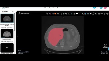 Liver Tumor Detection - DCMCloud