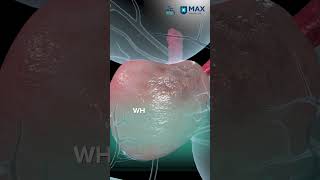 Understanding Psa & Prostate Cancer Diagnosis