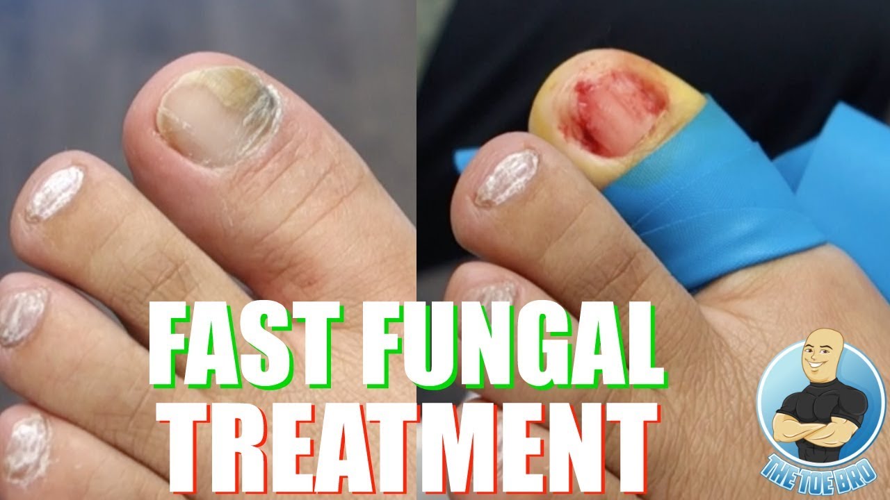 Nail Fungus Treatment Cream 30g Strong AntiFungus Nail Treatment for Toenail  Fungus Fungal Nail Treatment For Athletes Foot and Nail Infections  Repair and Promotes Healthy Nail Growth  Amazoncouk Beauty