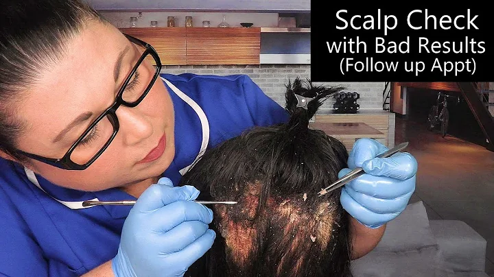 ASMR Scalp Check with Bad Results (Dry Skin Removal, Dandruff Removal, Scalp Treatment) Medical RP